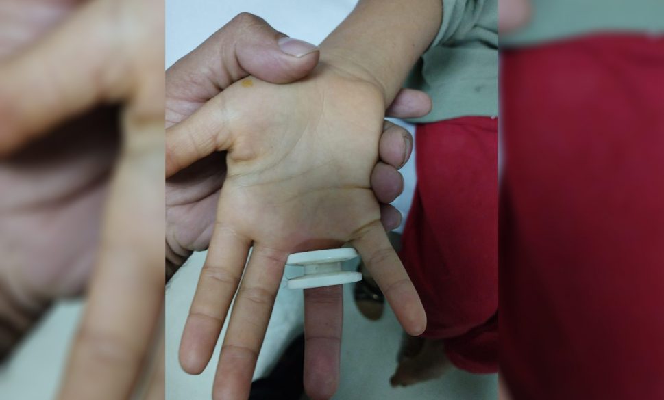 parmağına plastik cisim sıkışan çocuk kurtarıldı